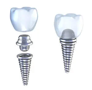 Cost of Dental Implants