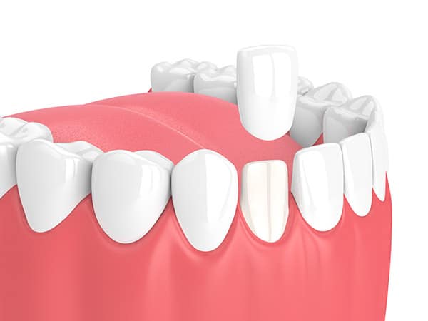 affordable-porcelain-veneers-bonney-lake-wa
