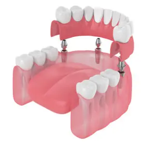 Dentures Bonney Lake