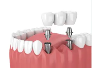 Dental Implants in Bonney Lake