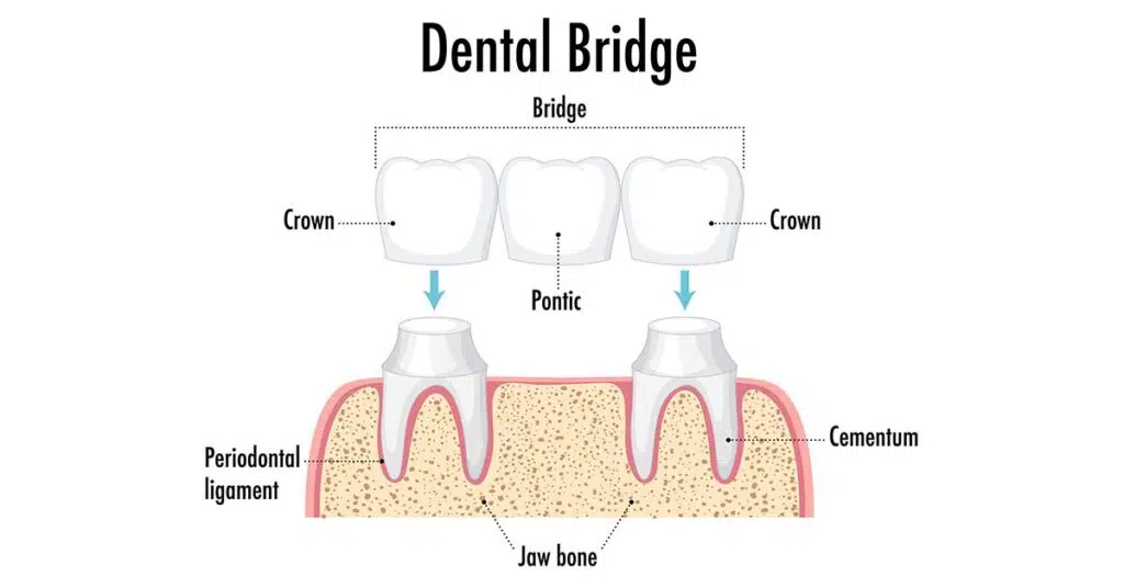 dentist bonneylake wa