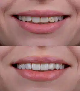 veneers Bonney Lake WA