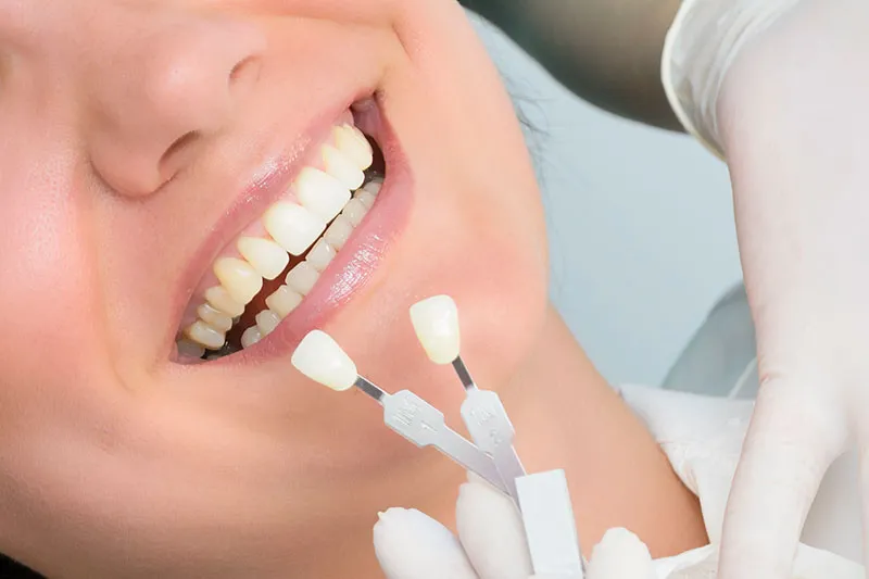 Veneers for a confident smile