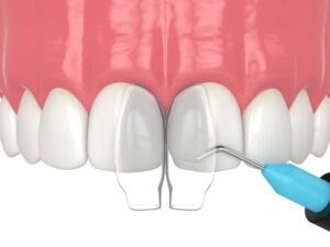 teeth bonding