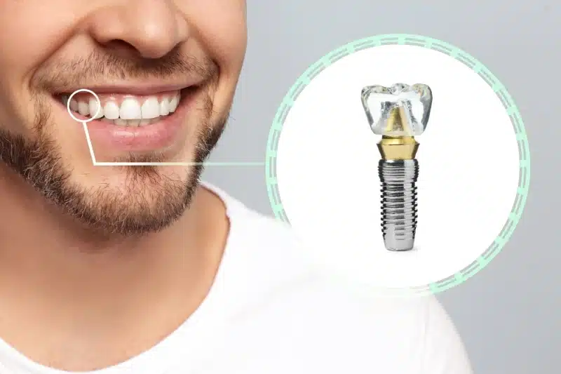 Patient smiling after dental implant treatment near Puyallup WA