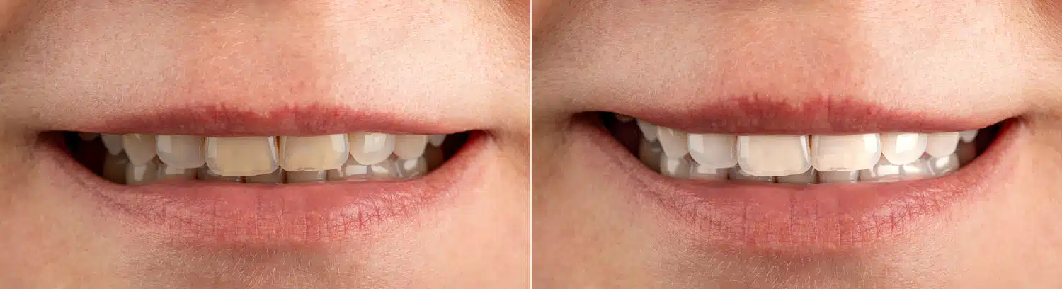 Close-up of professional teeth whitening treatment near Puyallup WA